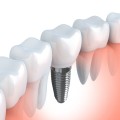 Dental implants