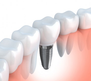 Dental implants