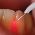 Laser dentistry