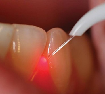 Laser dentistry