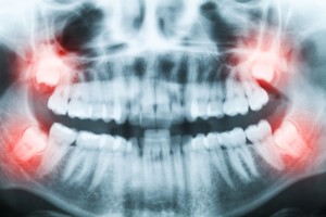 wisdom teeth embed within info