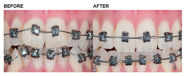 Comprehensive  Orthodontics: Example 1