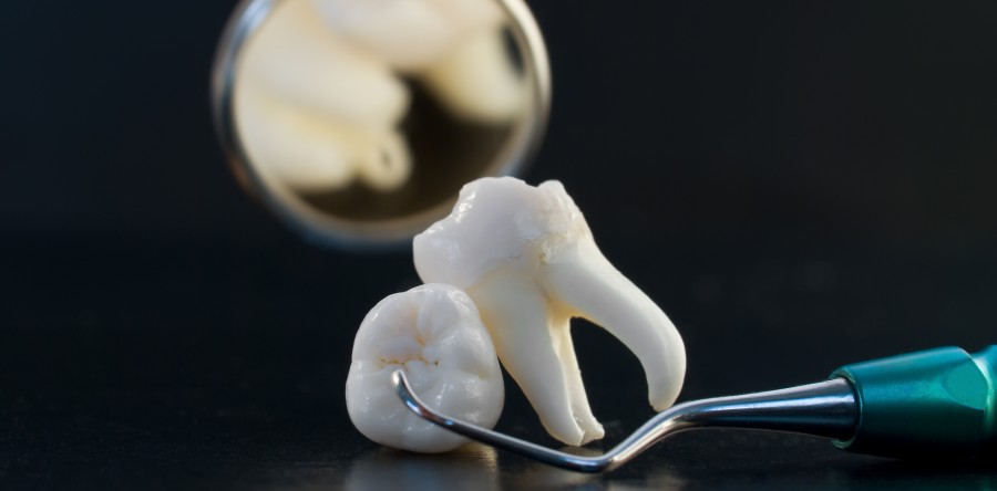 Wisdom teeth removal