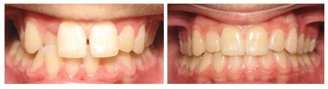 Invisalign Before and After: Example 2
