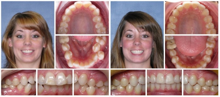 Invisalign Before and After: Example 4